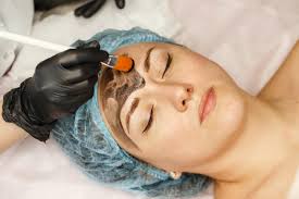 Hollywood Laser Peel Treatment